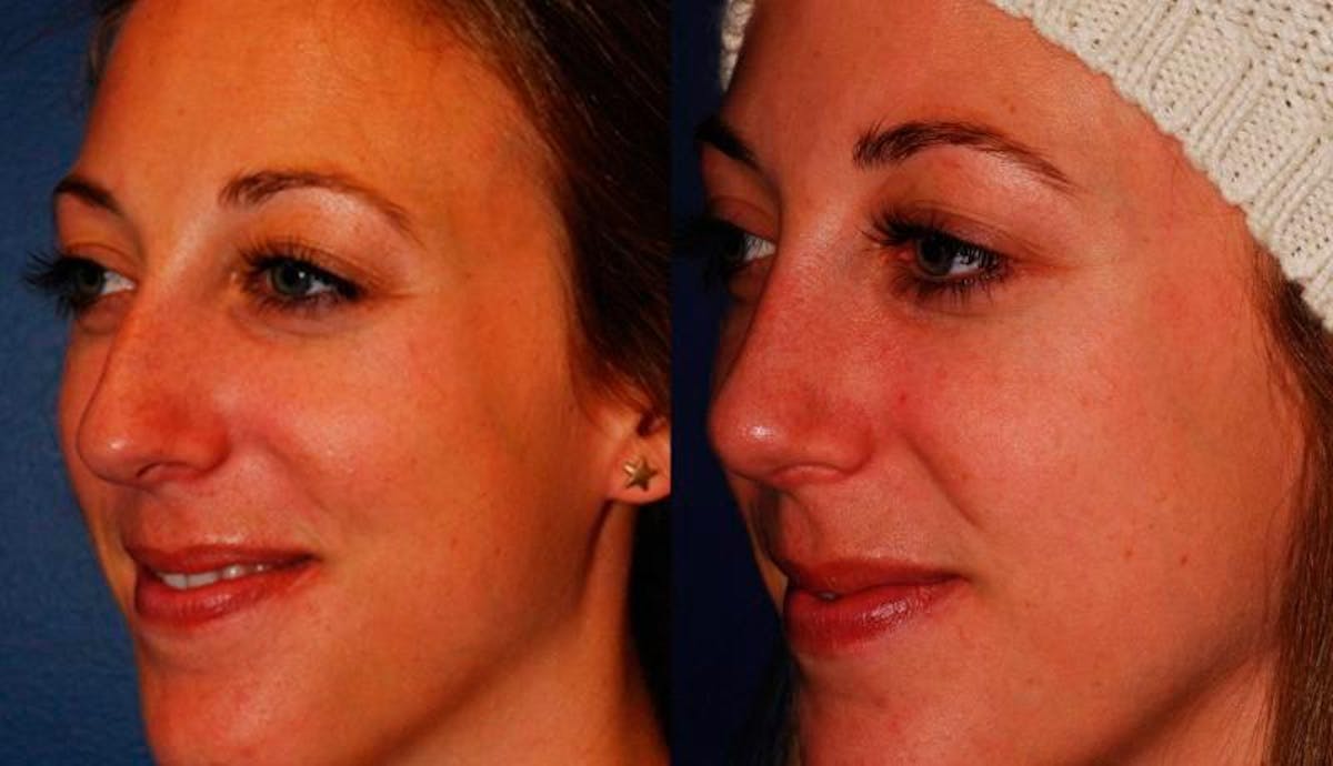 Rhinoplasty Before & After Gallery - Patient 329885 - Image 4