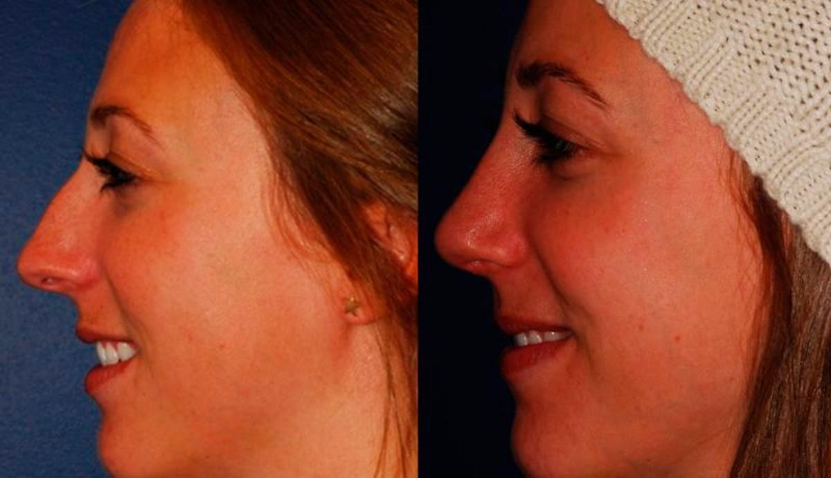 Rhinoplasty Before & After Gallery - Patient 329885 - Image 5
