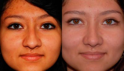 Rhinoplasty Before & After Gallery - Patient 243908 - Image 1