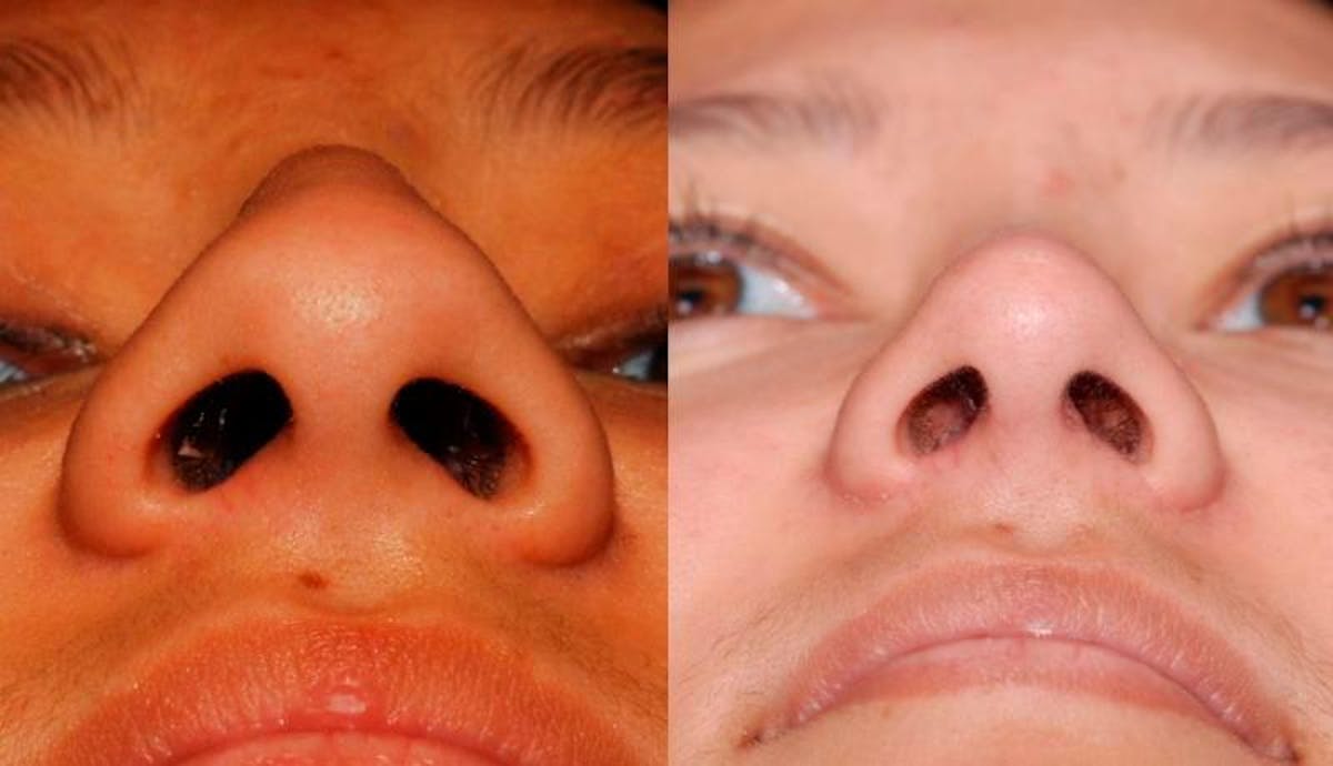Rhinoplasty Before & After Gallery - Patient 243908 - Image 2