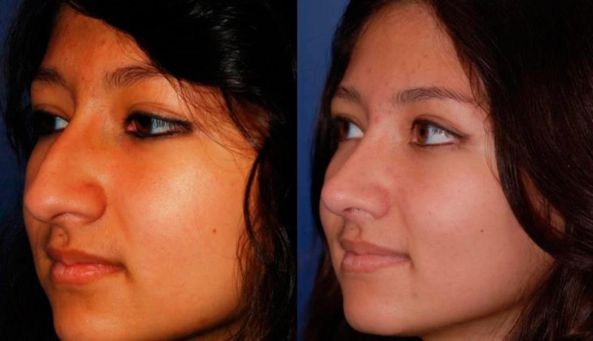Rhinoplasty Before & After Gallery - Patient 243908 - Image 3