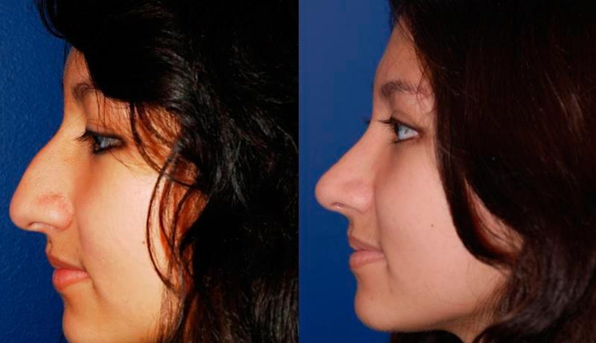 Rhinoplasty Before & After Gallery - Patient 243908 - Image 4