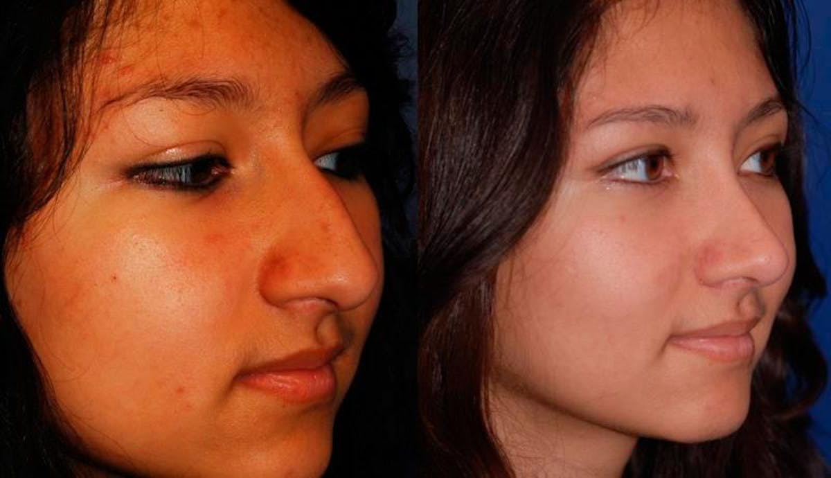 Rhinoplasty Before & After Gallery - Patient 243908 - Image 5