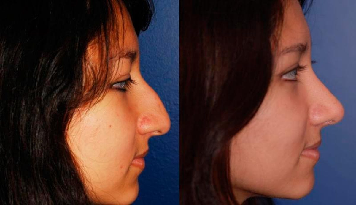 Rhinoplasty Before & After Gallery - Patient 243908 - Image 6