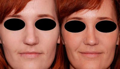 Rhinoplasty Before & After Gallery - Patient 284091 - Image 1