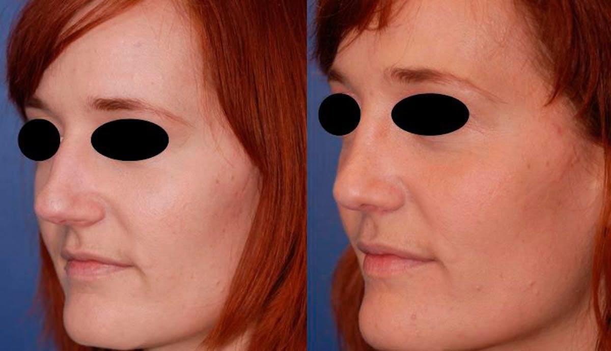 Rhinoplasty Before & After Gallery - Patient 284091 - Image 2