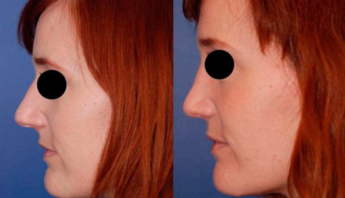 Rhinoplasty Before & After Gallery - Patient 284091 - Image 3