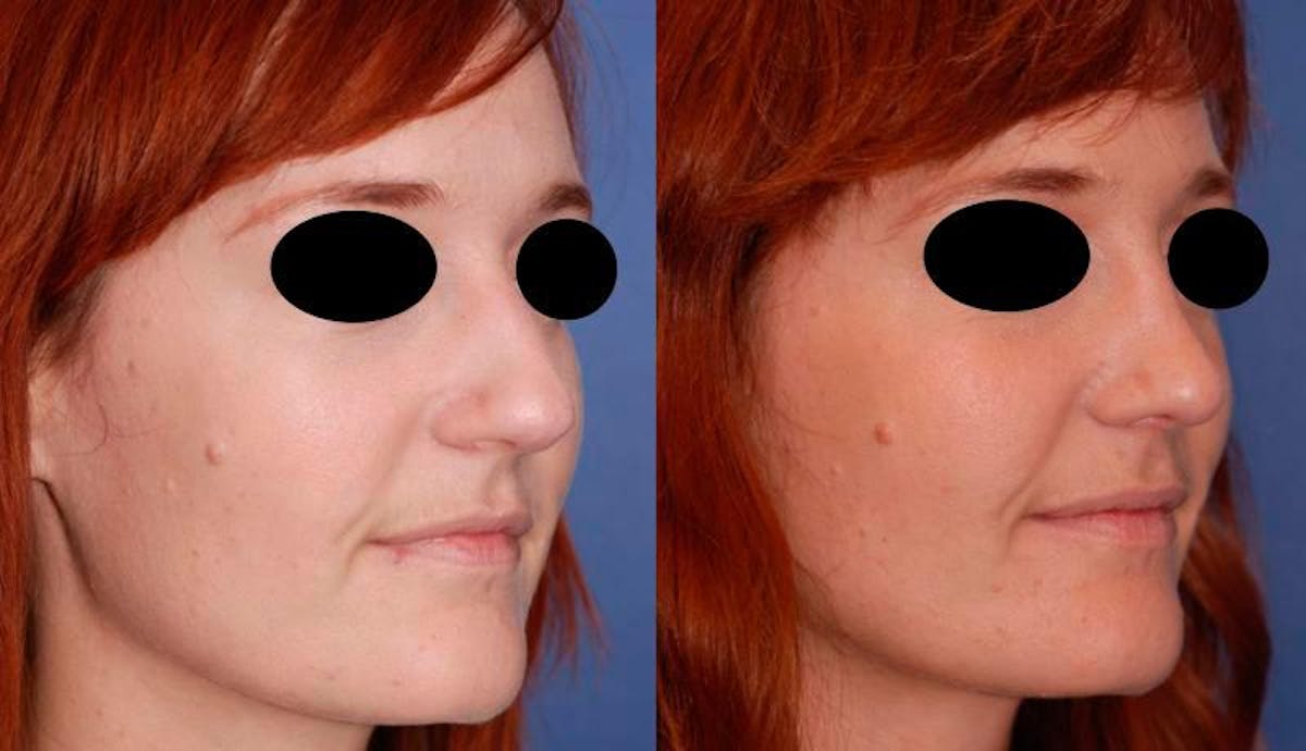 Rhinoplasty Before & After Gallery - Patient 284091 - Image 4