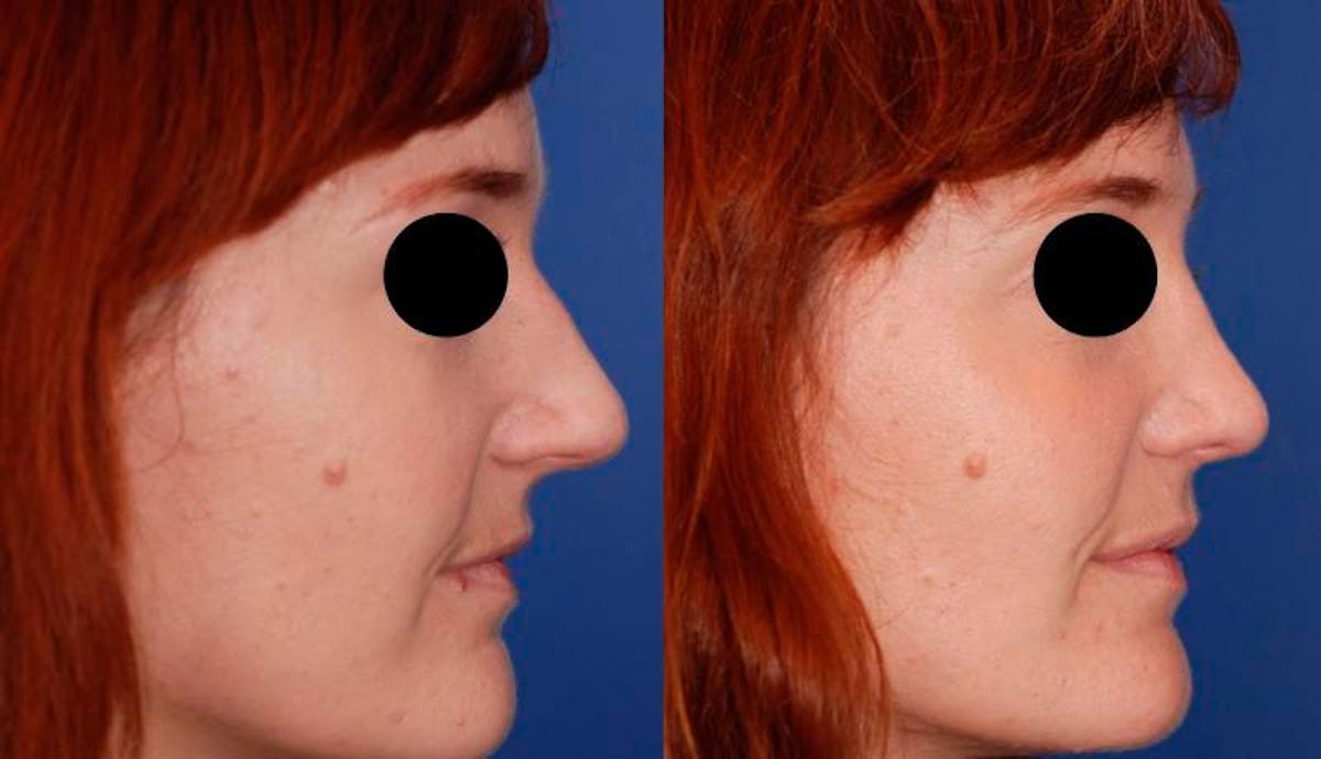 Rhinoplasty Before & After Gallery - Patient 284091 - Image 5