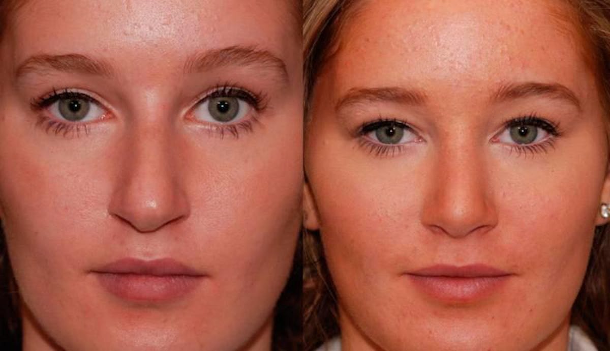 Rhinoplasty Before & After Gallery - Patient 224666 - Image 1