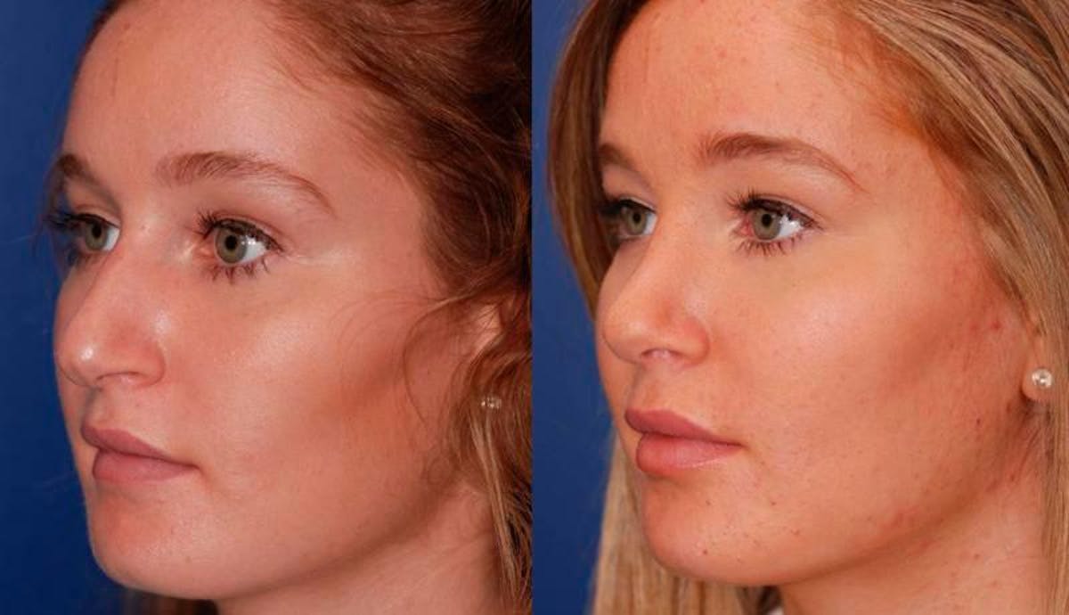 Rhinoplasty Before & After Gallery - Patient 224666 - Image 2