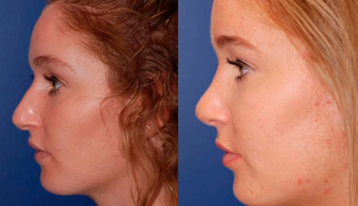 Rhinoplasty Before & After Gallery - Patient 224666 - Image 3