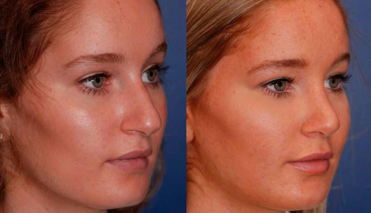 Rhinoplasty Before & After Gallery - Patient 224666 - Image 4