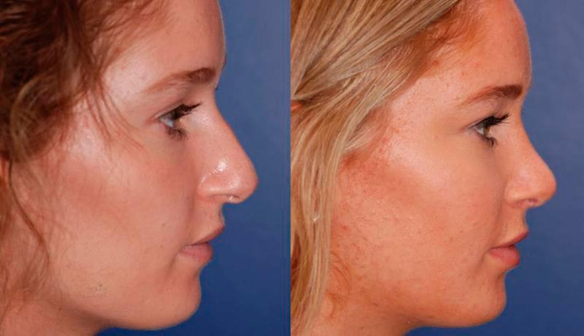 Rhinoplasty Before & After Gallery - Patient 224666 - Image 5