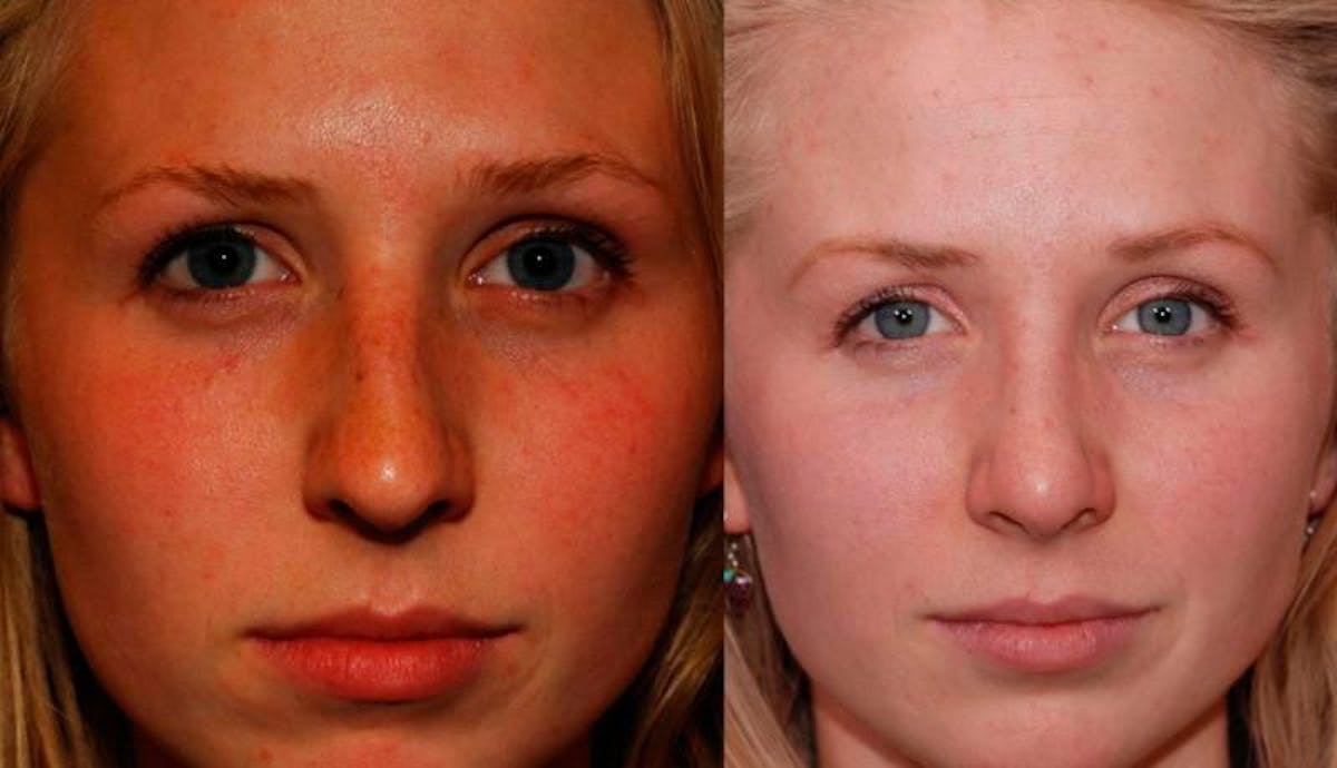 Rhinoplasty Before & After Gallery - Patient 516562 - Image 1