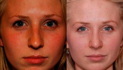 Rhinoplasty Before & After Gallery - Patient 516562 - Image 1