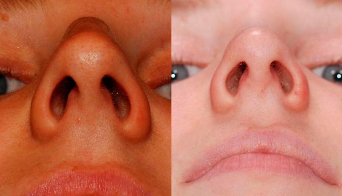 Rhinoplasty Before & After Gallery - Patient 516562 - Image 2