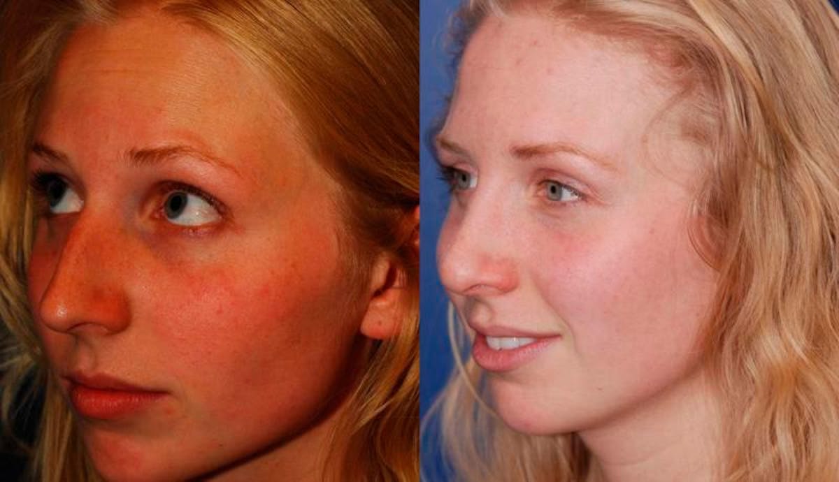 Rhinoplasty Before & After Gallery - Patient 516562 - Image 3
