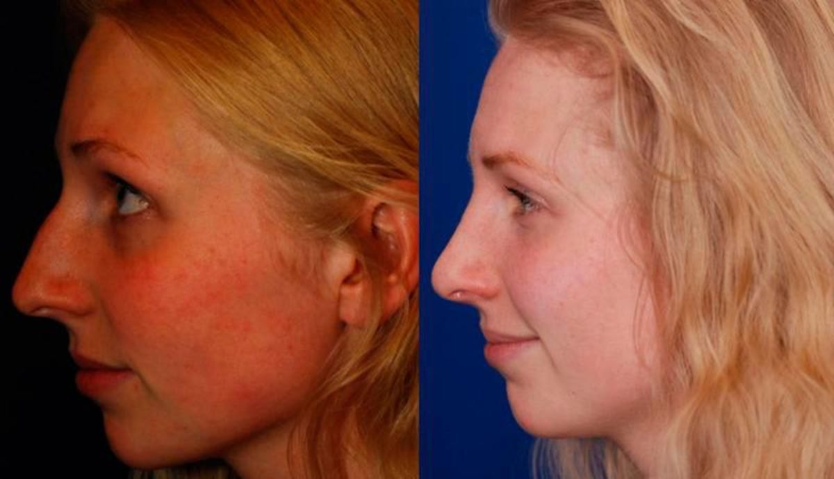 Rhinoplasty Before & After Gallery - Patient 516562 - Image 4