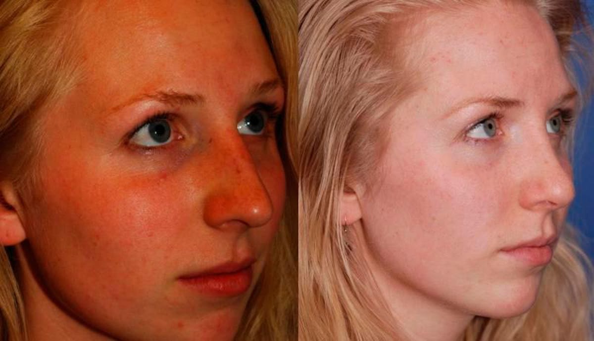 Rhinoplasty Before & After Gallery - Patient 516562 - Image 5