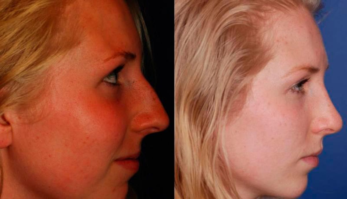 Rhinoplasty Before & After Gallery - Patient 516562 - Image 6