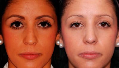 Rhinoplasty Before & After Gallery - Patient 276166 - Image 1