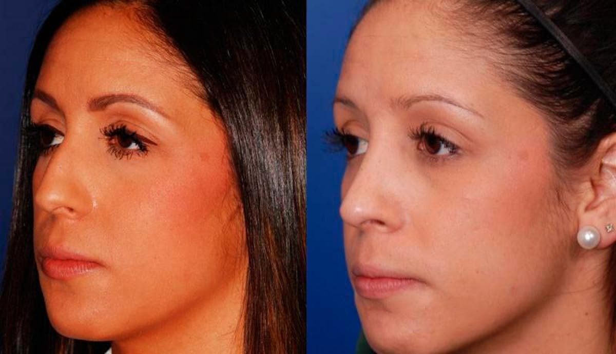 Rhinoplasty Before & After Gallery - Patient 276166 - Image 2