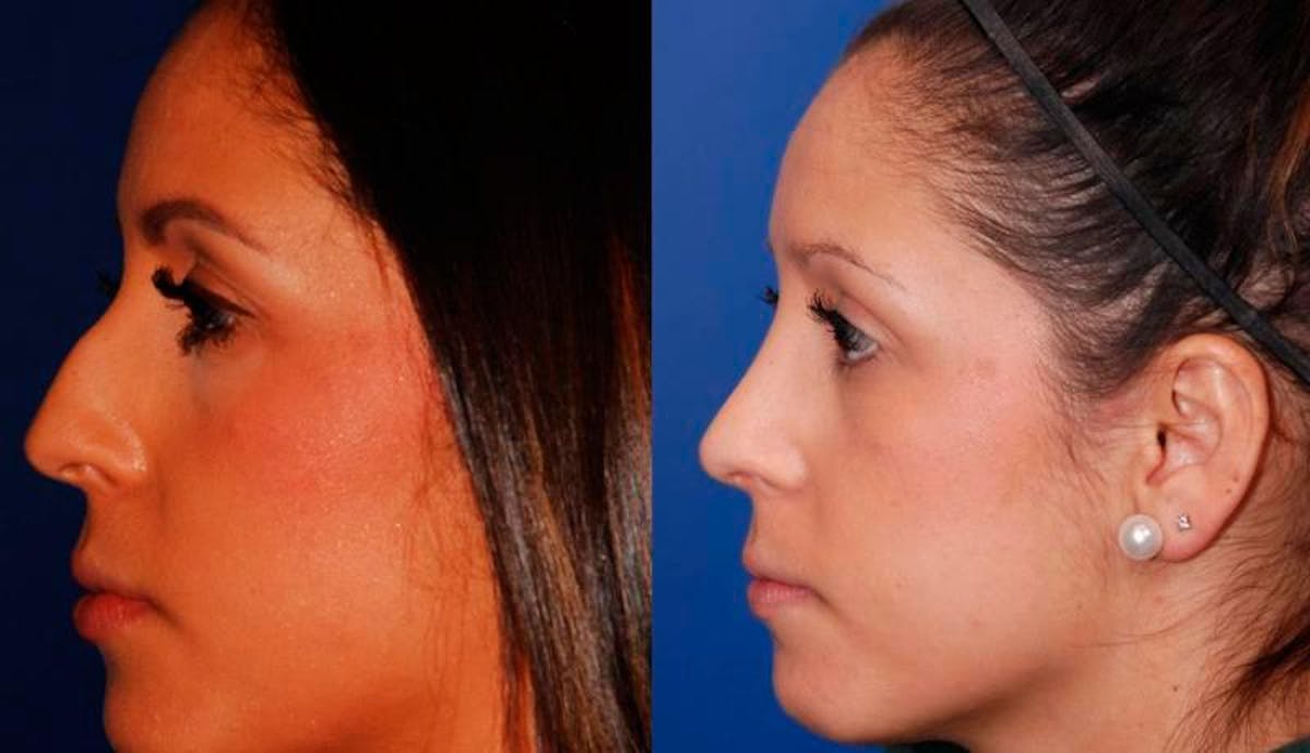 Rhinoplasty Before & After Gallery - Patient 276166 - Image 3