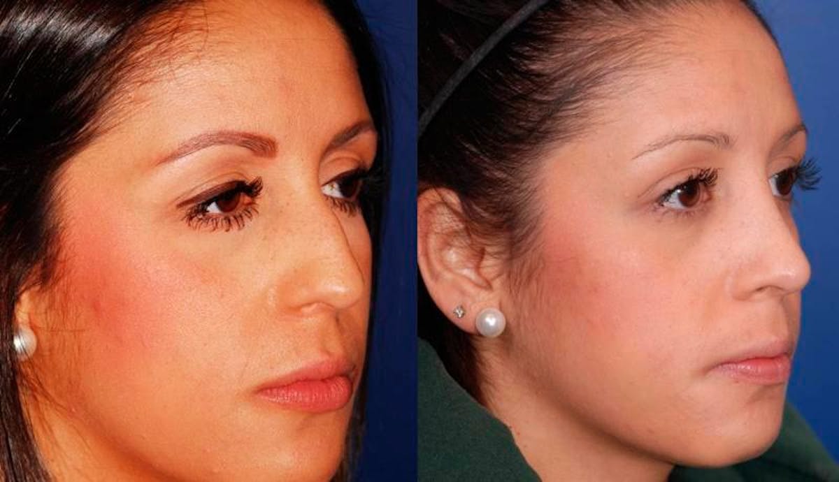 Rhinoplasty Before & After Gallery - Patient 276166 - Image 4