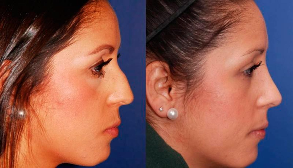 Rhinoplasty Before & After Gallery - Patient 276166 - Image 5