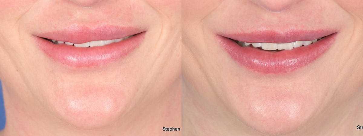 Scar Revision Before & After Gallery - Patient 143882 - Image 1