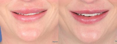 Scar Revision Before & After Gallery - Patient 143882 - Image 1