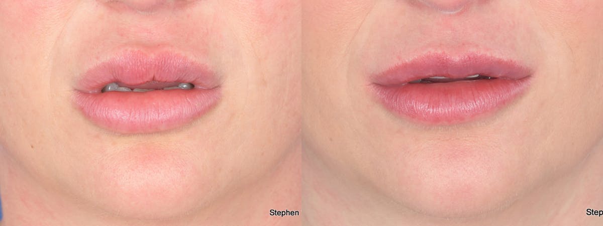 Scar Revision Before & After Gallery - Patient 143882 - Image 2