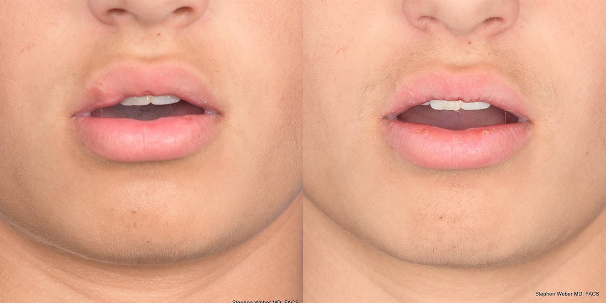 Scar Revision Before & After Gallery - Patient 104455 - Image 1