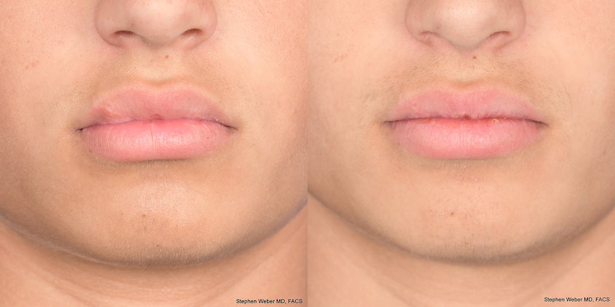 Scar Revision Before & After Gallery - Patient 104455 - Image 2