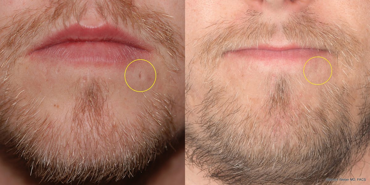 Scar Revision Before & After Gallery - Patient 203789 - Image 1