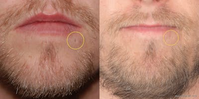 Scar Revision Before & After Gallery - Patient 203789 - Image 1