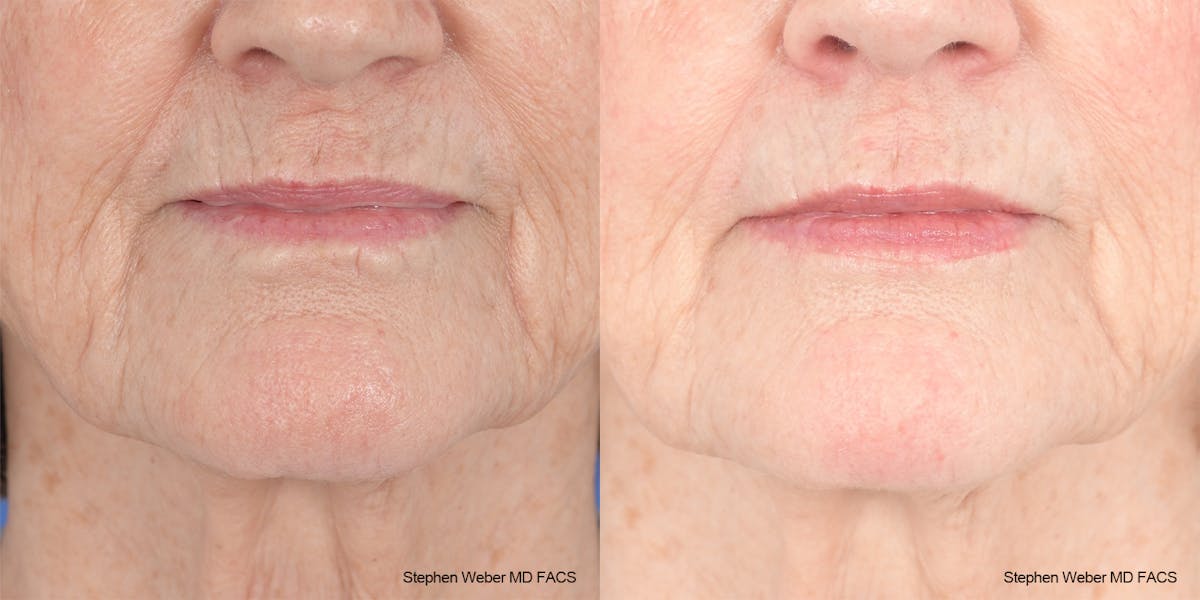 Scar Revision Before & After Gallery - Patient 180665 - Image 1