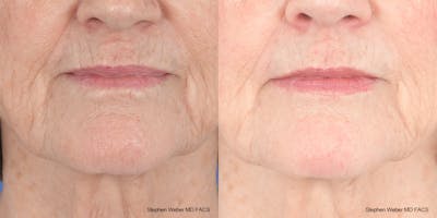 Scar Revision Before & After Gallery - Patient 180665 - Image 1