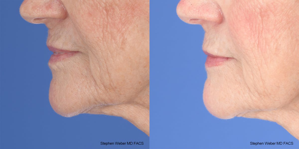 Scar Revision Before & After Gallery - Patient 180665 - Image 2