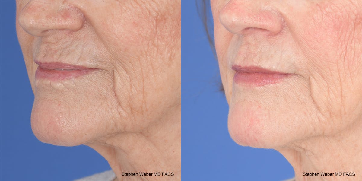 Scar Revision Before & After Gallery - Patient 180665 - Image 3