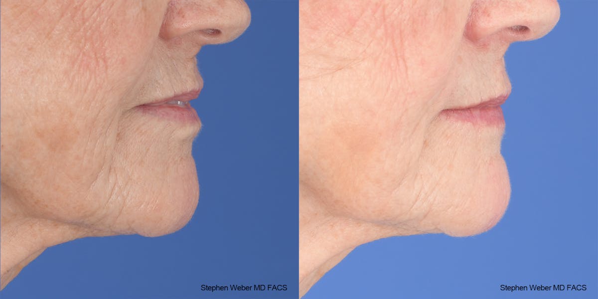 Scar Revision Before & After Gallery - Patient 180665 - Image 4