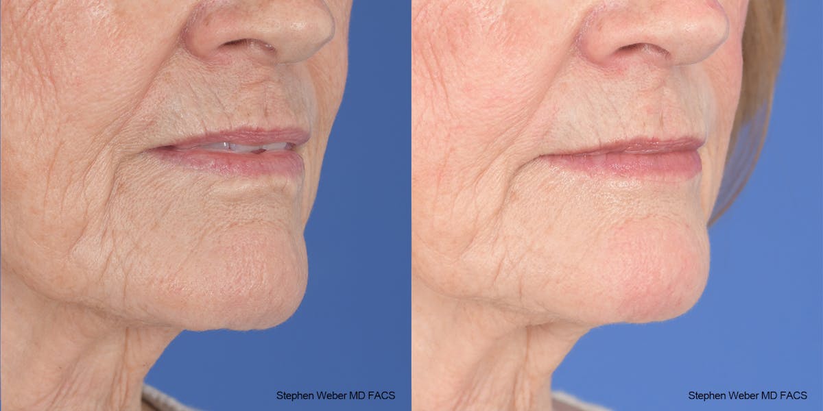 Scar Revision Before & After Gallery - Patient 180665 - Image 5