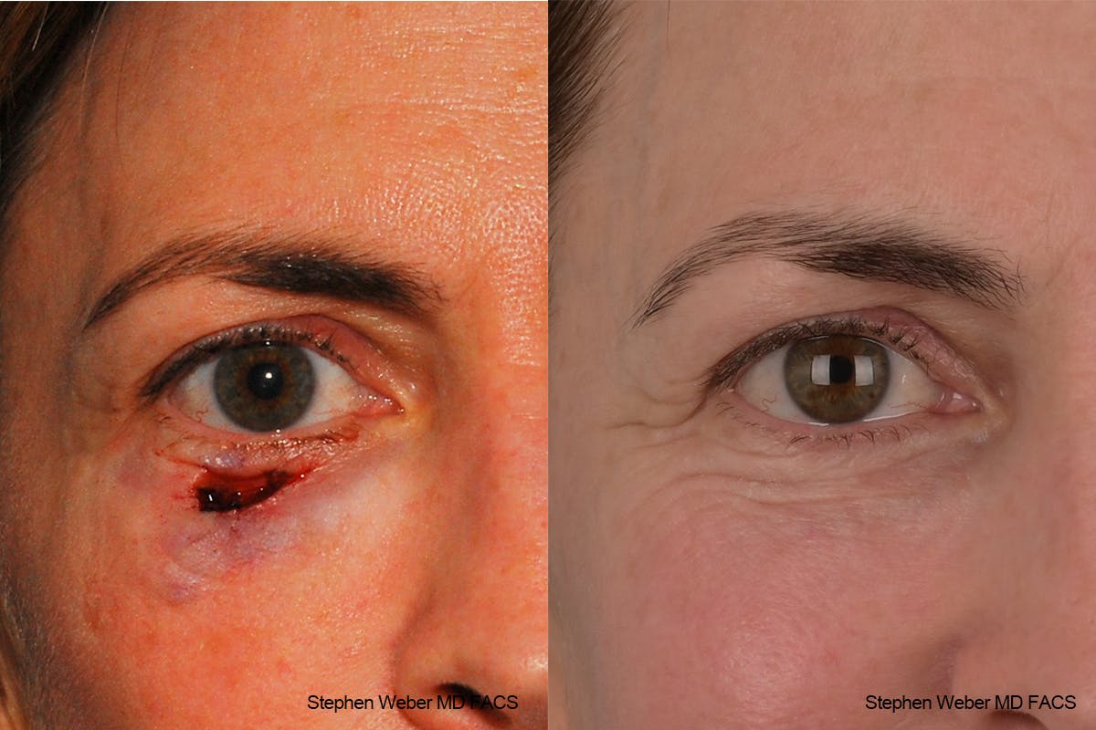 Scar Revision Before & After Gallery - Patient 639414 - Image 1