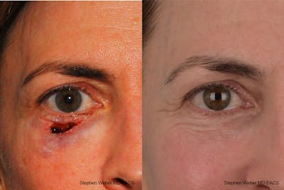 Scar Revision Before & After Gallery - Patient 639414 - Image 1