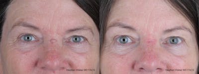 Scar Revision Before & After Gallery - Patient 135914 - Image 1