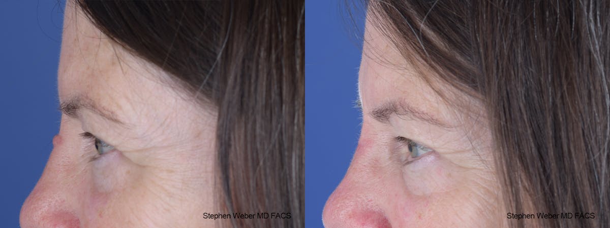 Scar Revision Before & After Gallery - Patient 135914 - Image 2