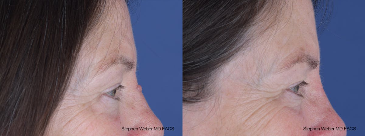 Scar Revision Before & After Gallery - Patient 135914 - Image 3
