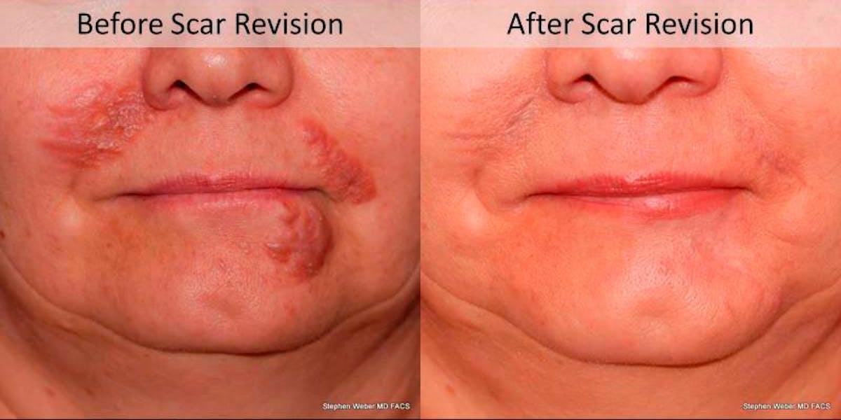 Scar Revision Before & After Gallery - Patient 269342 - Image 1