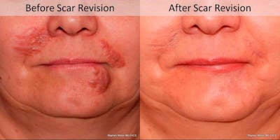Scar Revision Before & After Gallery - Patient 269342 - Image 1